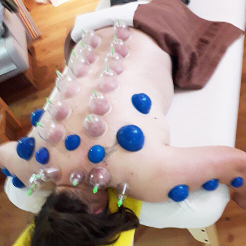 Schröpfen (c) Klein Karin